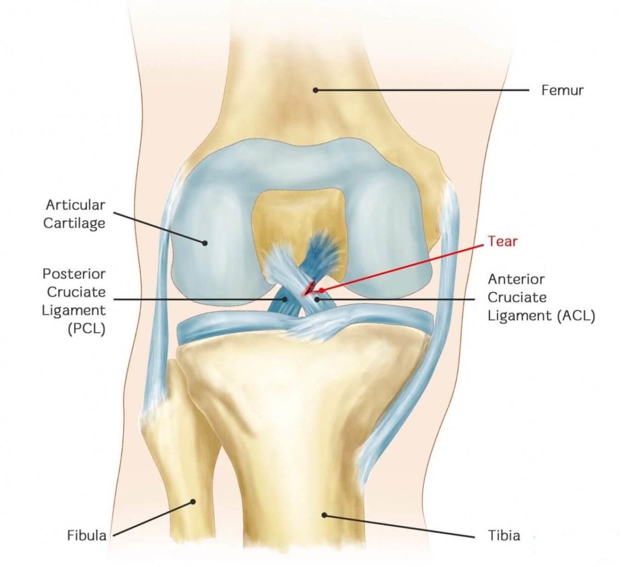 ACL INJURIES - Movement Perfected
