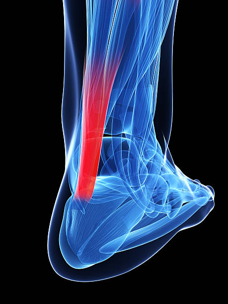 Achilles Tendinopathy and Rupture of the achilles tendon